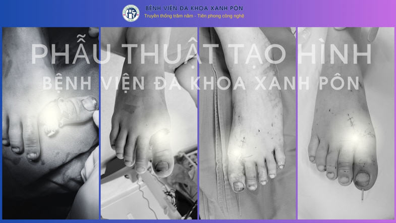 Khoa Tạo hình Thẩm mỹ - Bệnh viện Đa khoa Xanh Pôn: Kỹ thuật vi phẫu trong điều trị đứt rời ngón chân